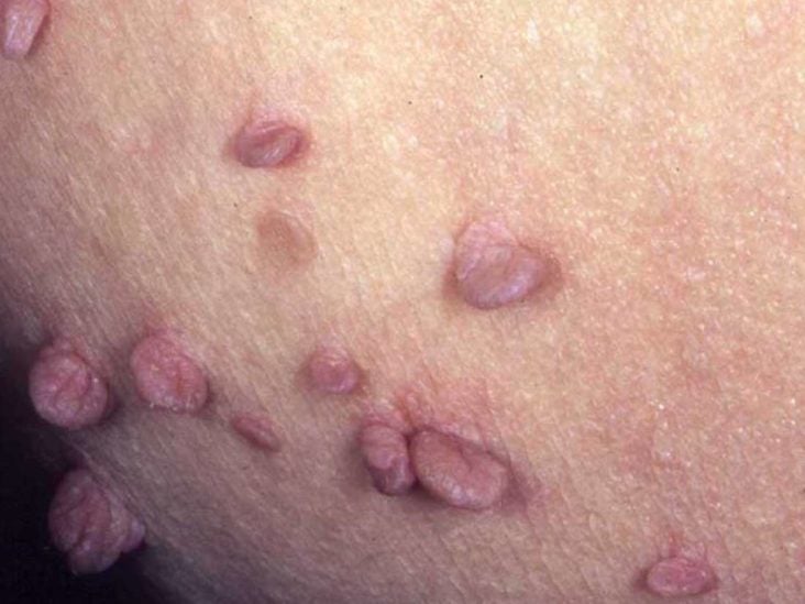 Penis on raised mole Lump on