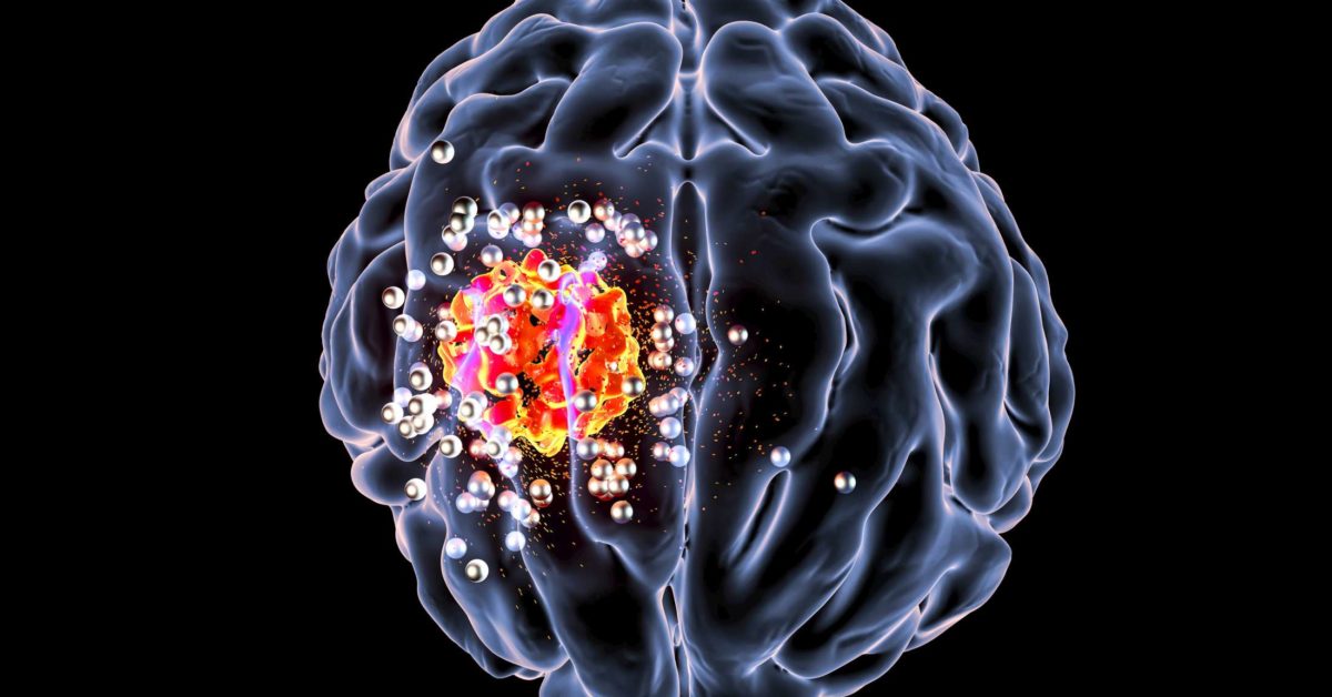 How Big Can A Brain Tumor Get Before It Kills You