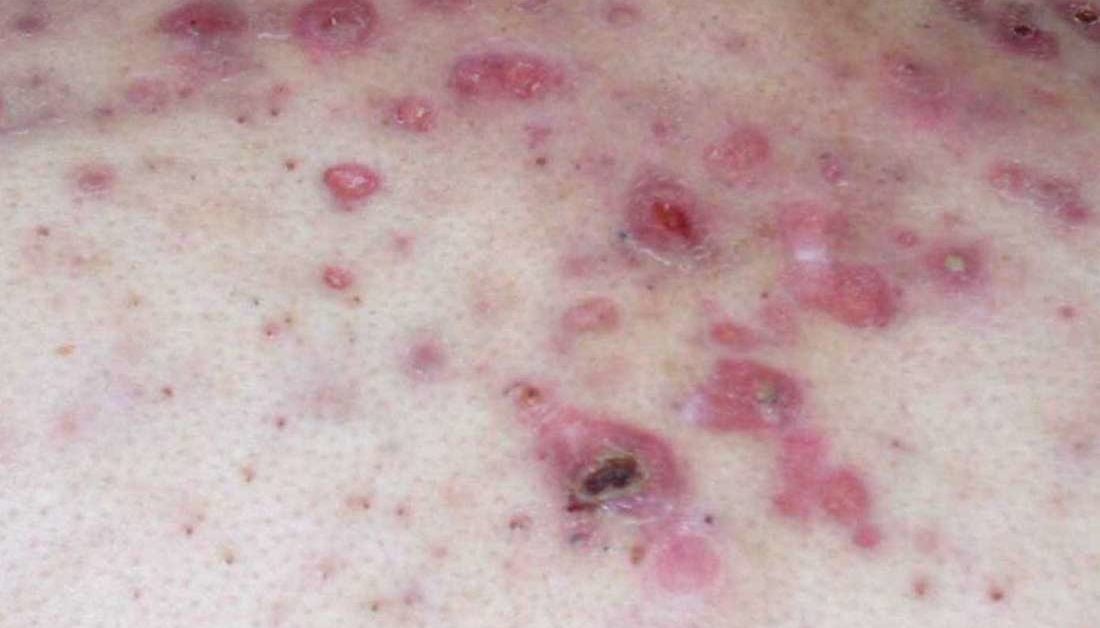 Nodular acne: Treatment and home remedies