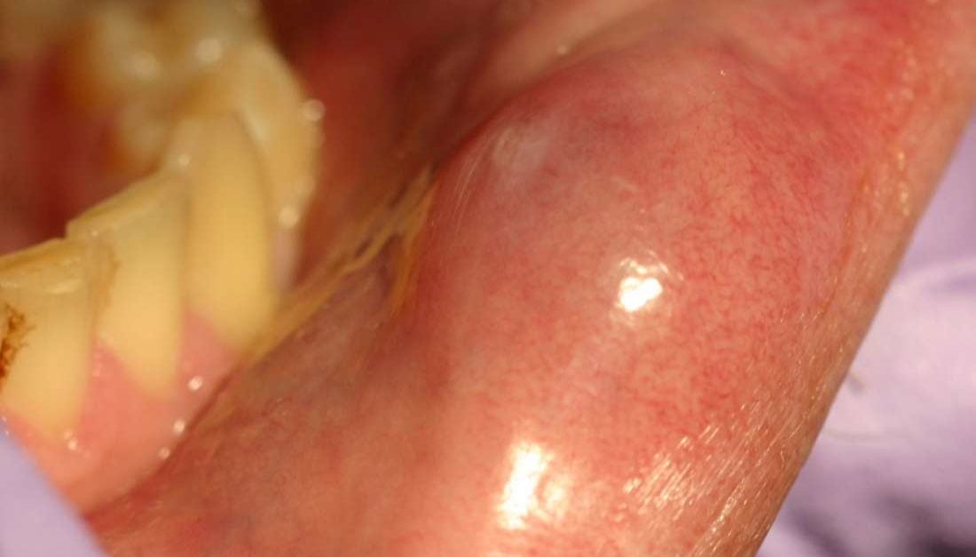 Mucous Cyst Types Causes And Treatment