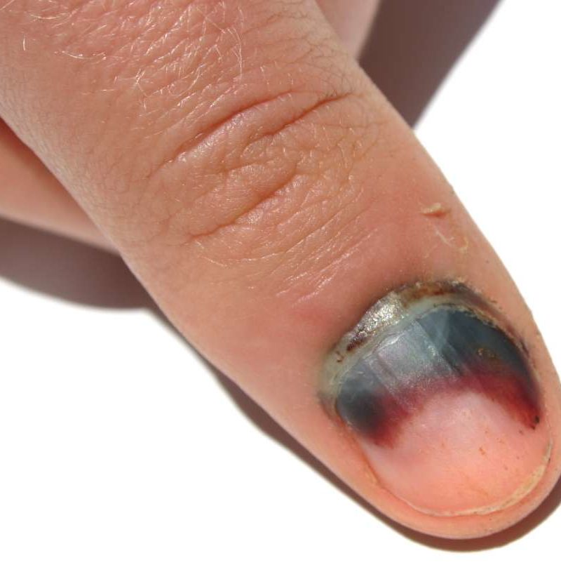 trauma nail treatment