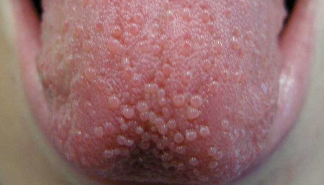 white-spots-on-tongue-white-spots-on-tongue-bumps-patches-painful