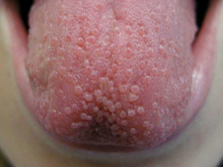 what does a healthy tongue look like