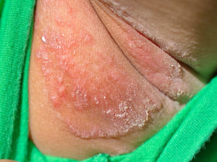 Skin rubbed raw