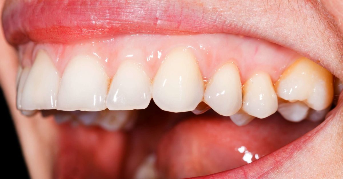 What Do Red Spots On Your Gums Mean