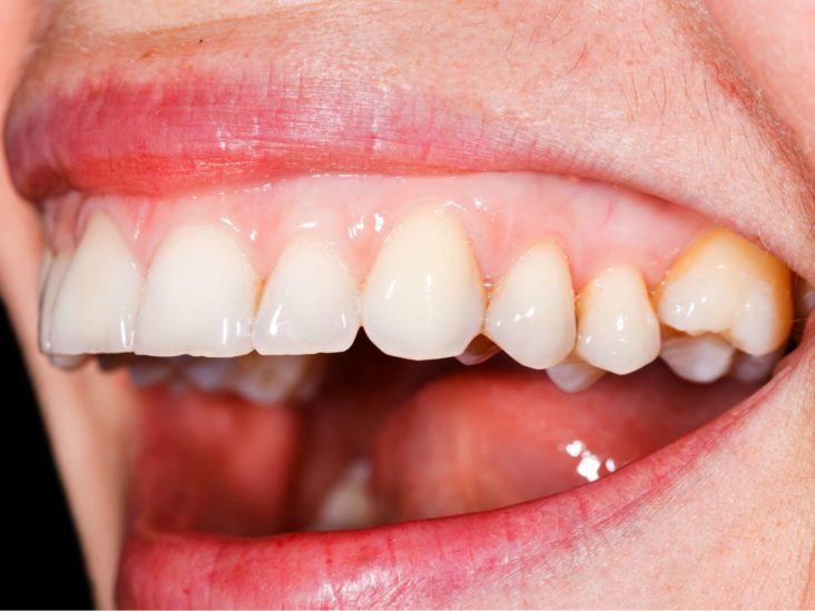 white gum infection