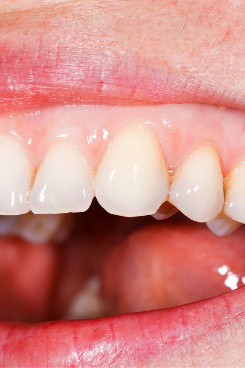 Pale gums Causes, symptoms, treatment, and warning signs