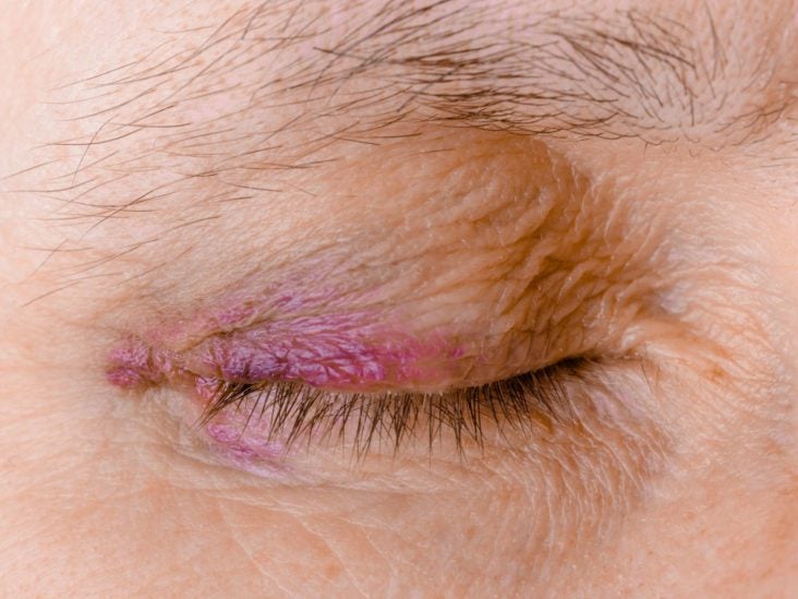 Ecchymosis: Definition, causes, treatment