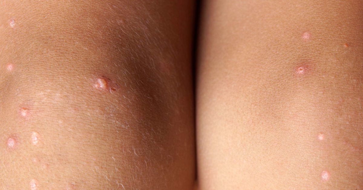 Pimples on legs: Causes and treatment