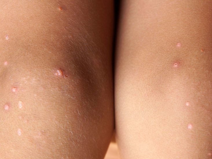 skin hardening on legs