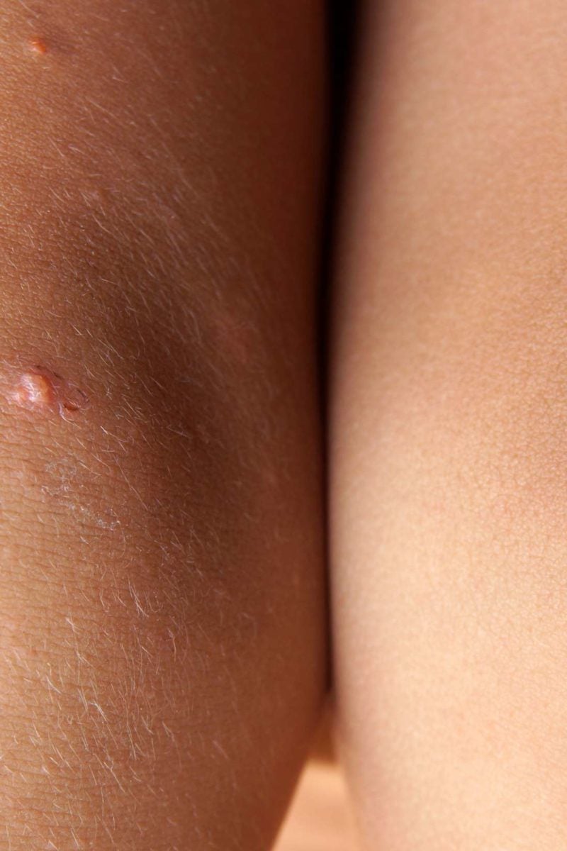 Pimples On Legs Causes And Treatment