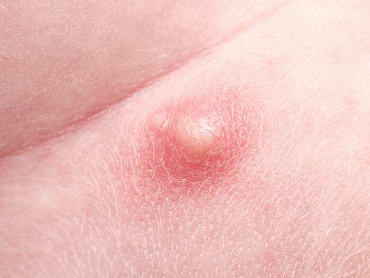 Pimple on scrotum: Causes, types, to a doctor