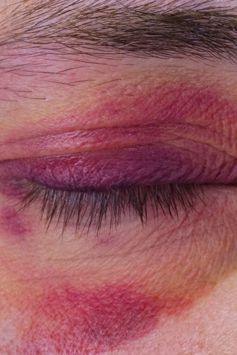 Bloke shares footage of his bloodied eyelid after ripping it open