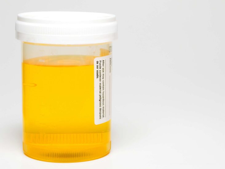 From multivitamins pee yellow Urine color
