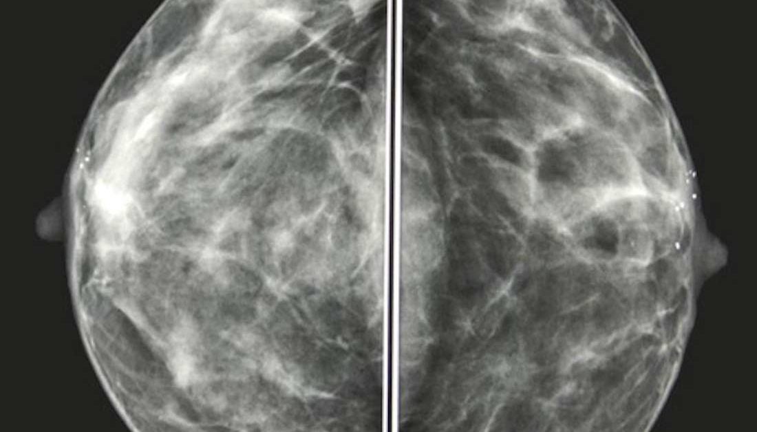 mammogram-images-normal-abnormal-and-breast-cancer