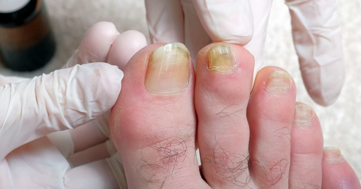 Why Are Toenails Hard And Thick