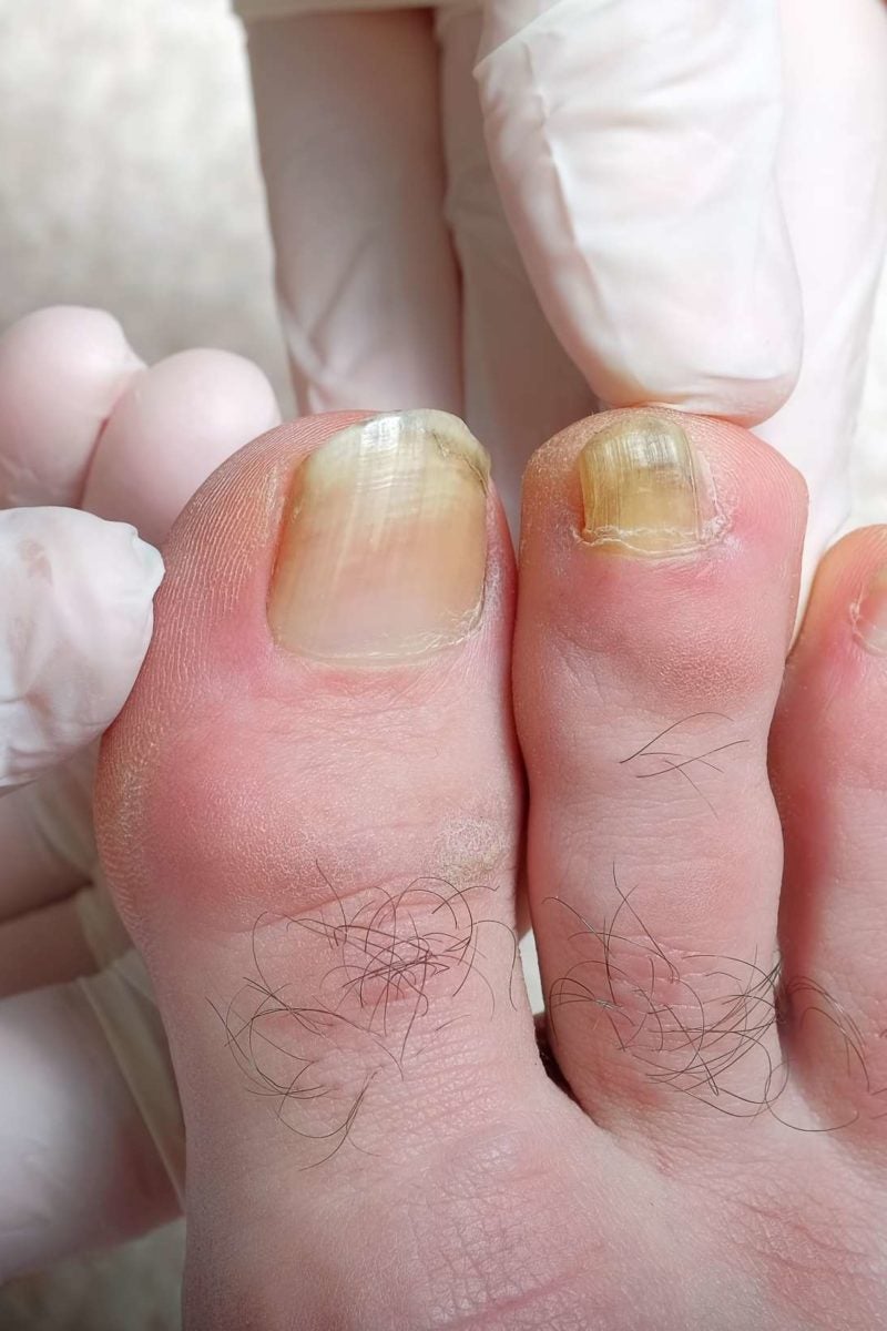 Why Would A Toe Nail Turn Yellow