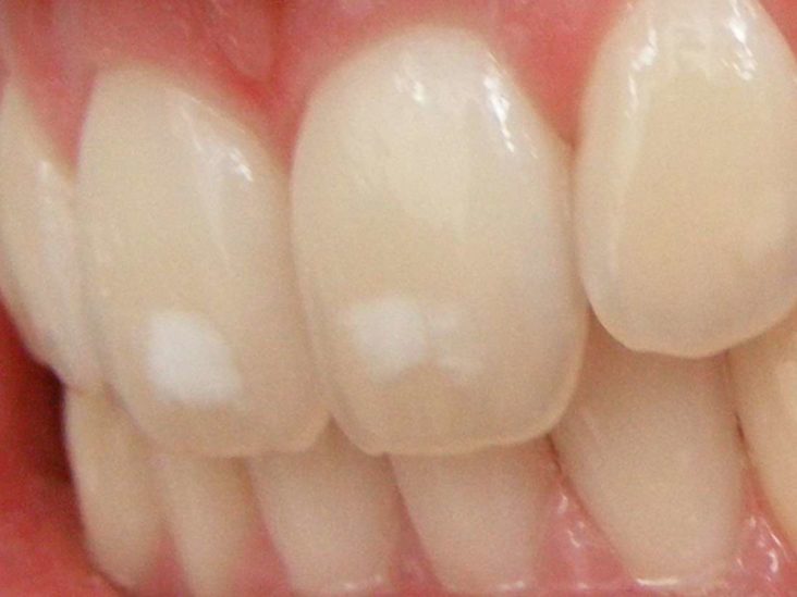 De Alpen Afhankelijkheid Fabel White spots on teeth: 11 tips on how to get rid of them