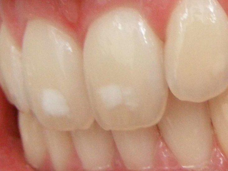 fluoride make teeth whiter