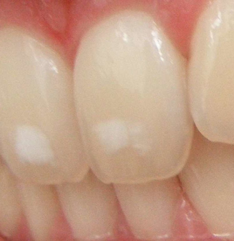 White Spots On Teeth 11 Tips On How To Get Rid Of Them