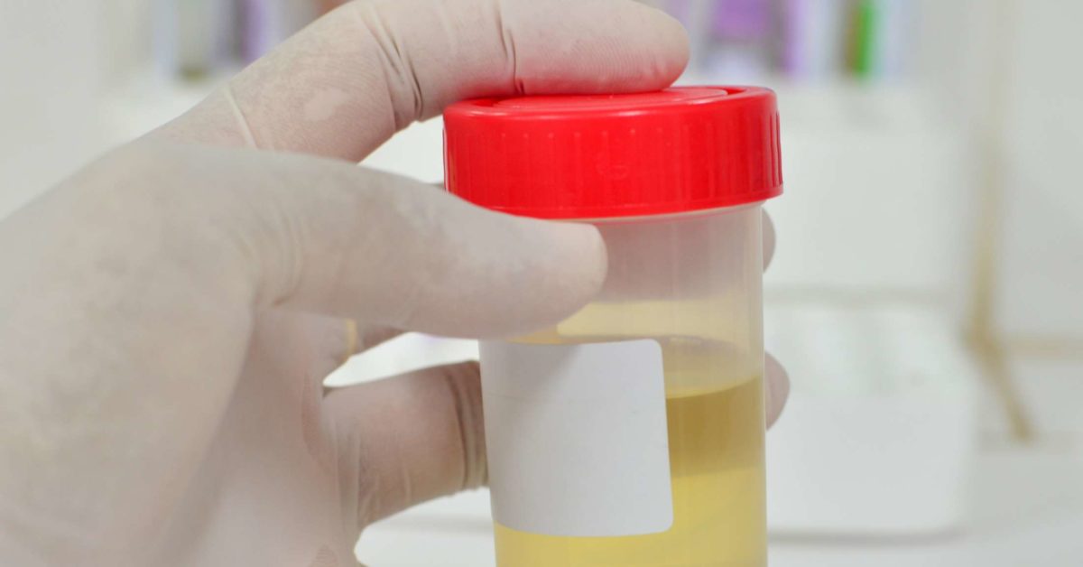 What Causes High Specific Gravity In Urine