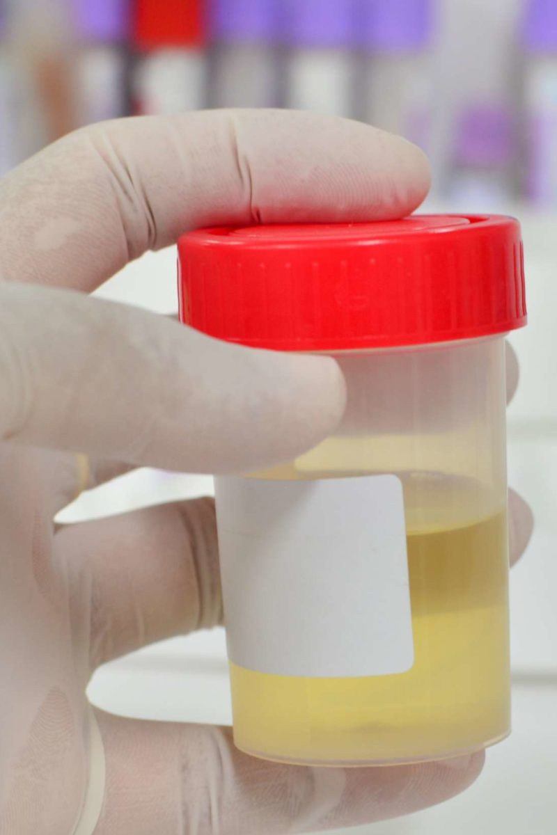 What Is The Urine Specific Gravity Test Used For