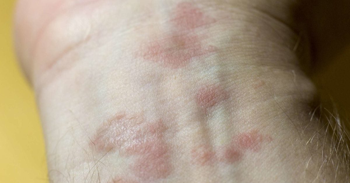 Allergic eczema Causes, symptoms, and pictures Allergic eczema Causes, symptoms, and pictures