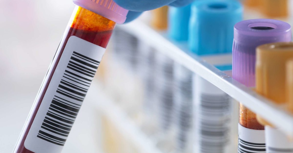 Lipase test What is it, results, and lowering levels