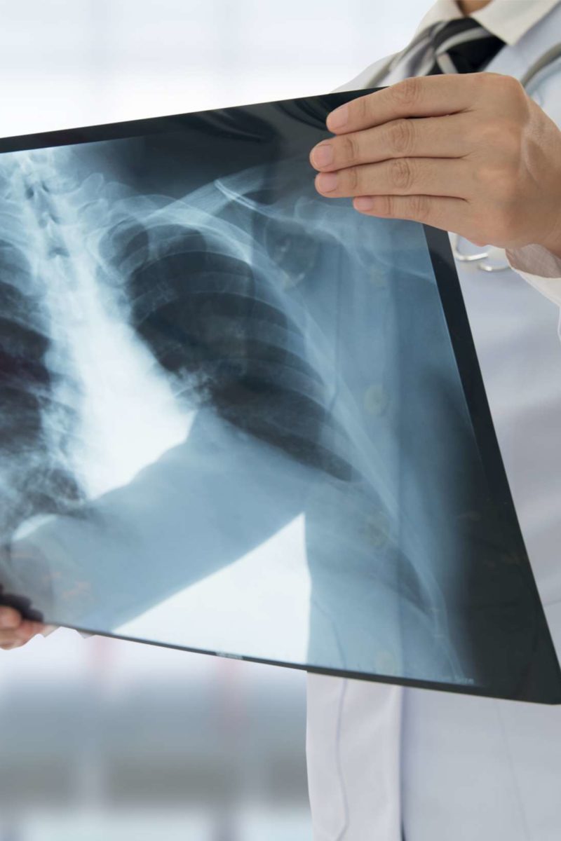 Is vitamin D deficiency to blame for lung disease?