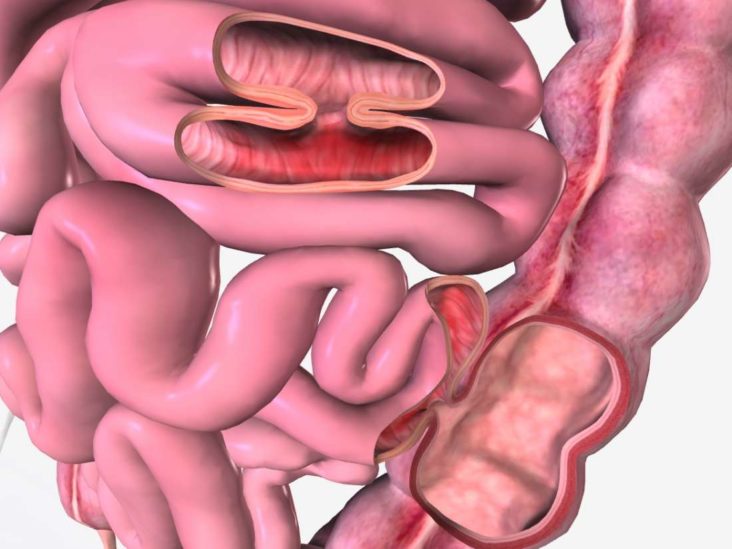 vesicocolic fistula