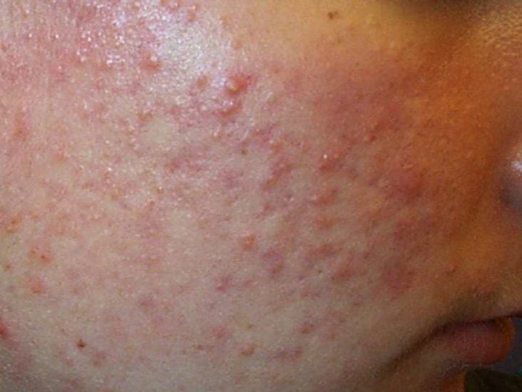 Comedonal Acne Pictures Treatment And Remedies