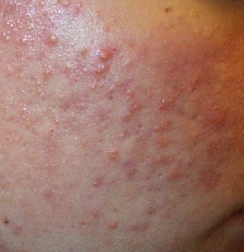 Acne types in pictures: Explanations and treatments