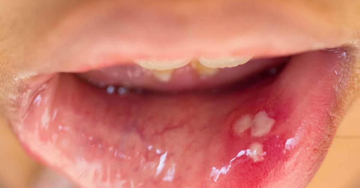 papilloma virus na boca