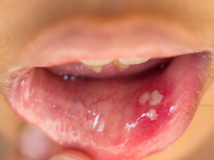 wart tongue hurts