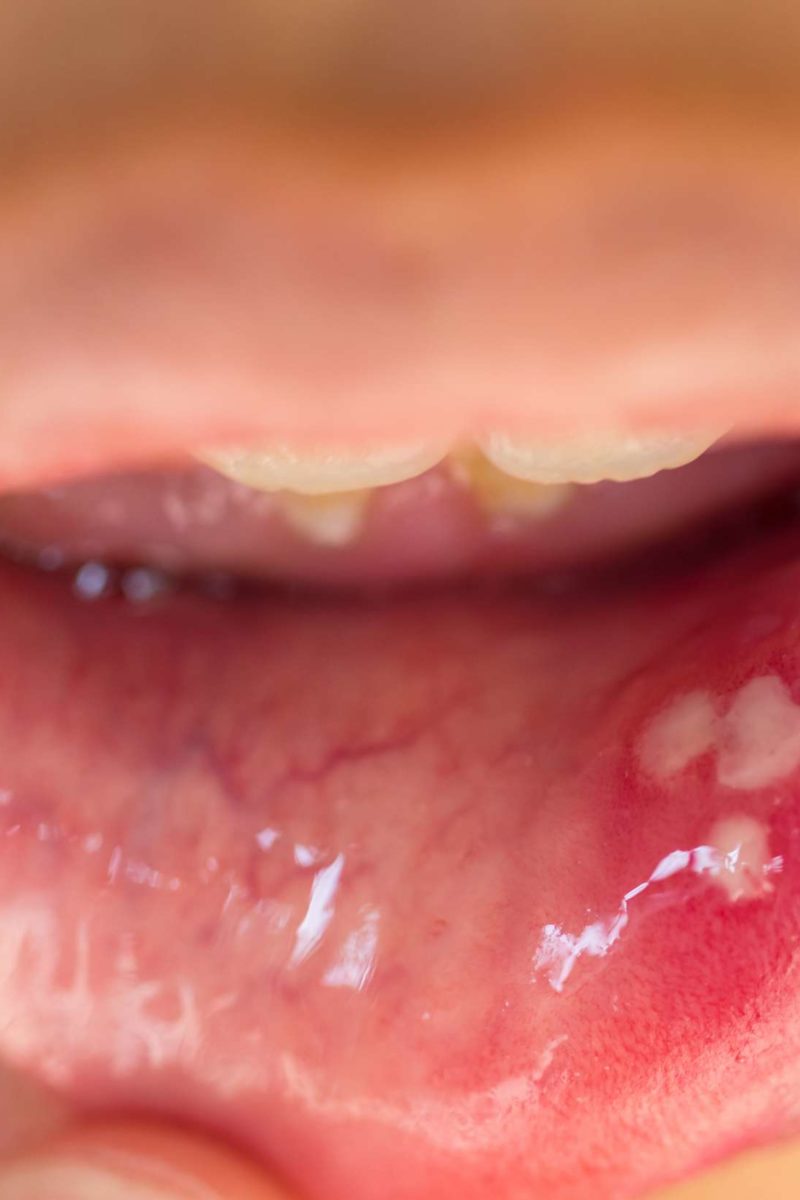 hpv-tongue-lesions