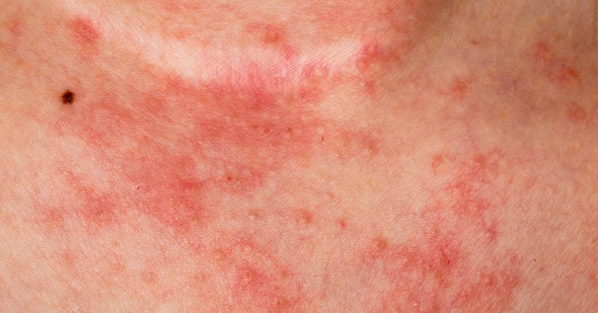 eczema causas vörös domború folt kissé viszket