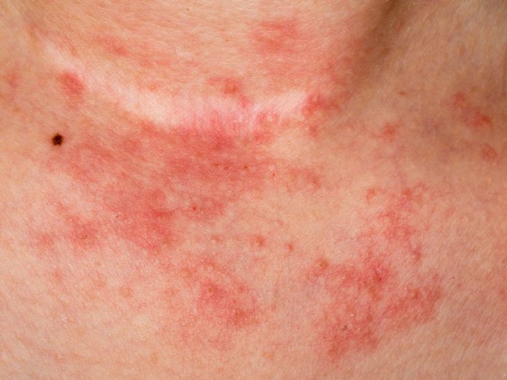 Seborrheás dermatitis a péniszen. 4 bőrprobléma, ami a nemi szervet (is) érintheti - Dívány