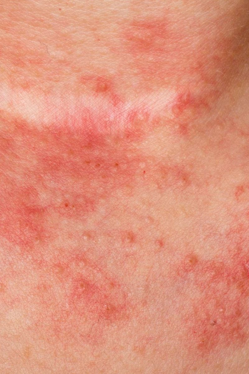 6 Tipos De Eczema Síntomas Y Causas