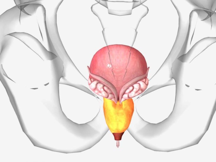 hipertrofia prostática grado iv operatie laparoscopica cancer de prostata