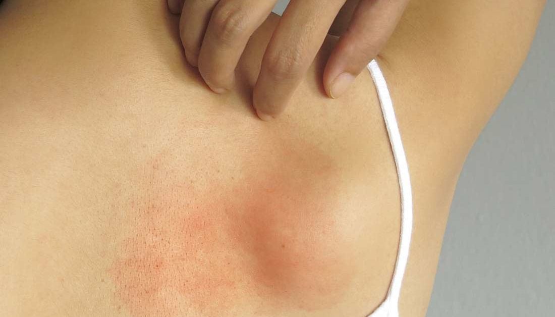 Ask the doctor: Should I be worried about the weird rash under my breasts?