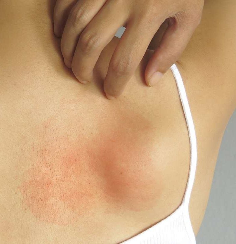 rash between buttocks burns