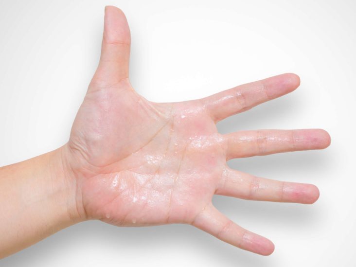 Hyperhidrosis: causes, diagnosis, and treatment