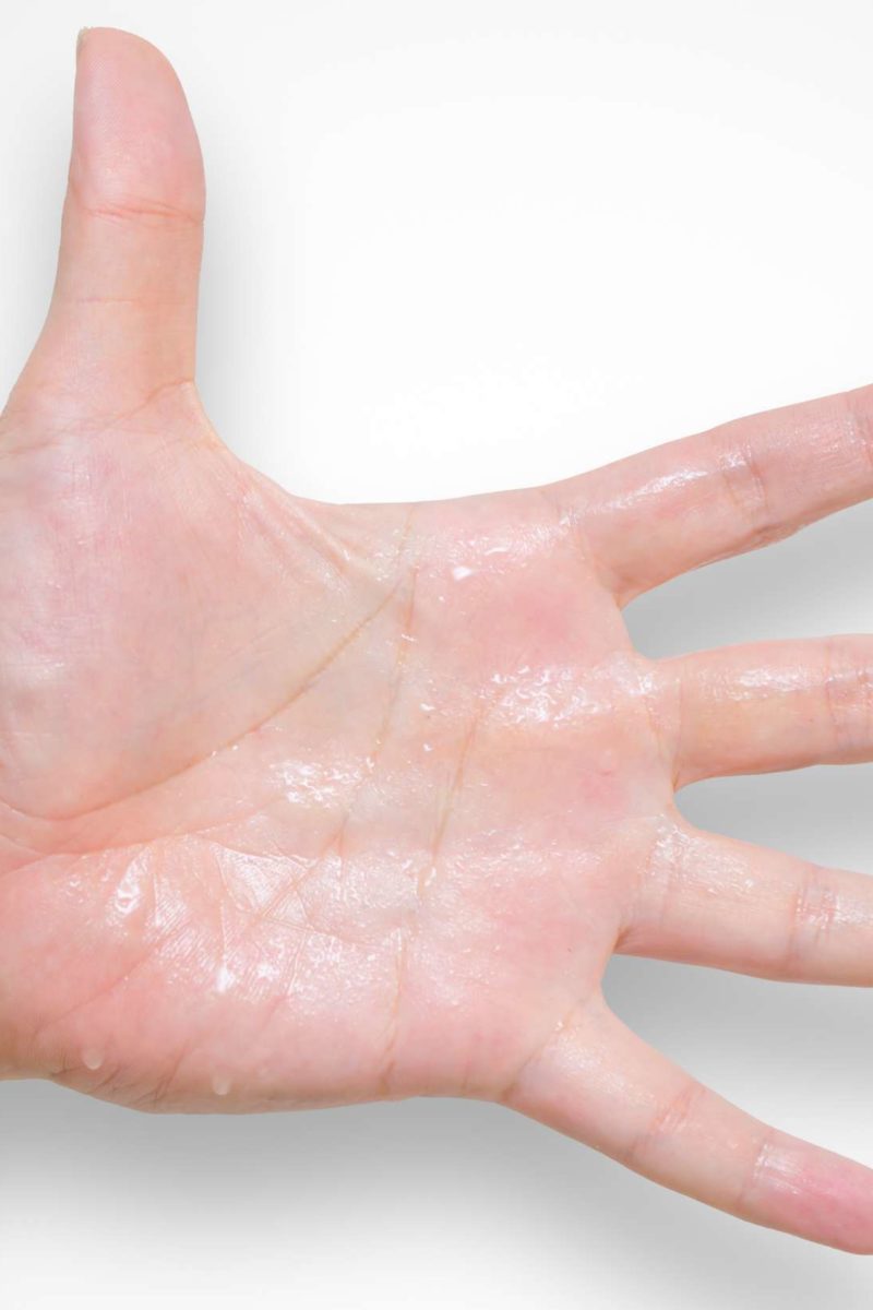 What Causes Clammy Sticky Hands