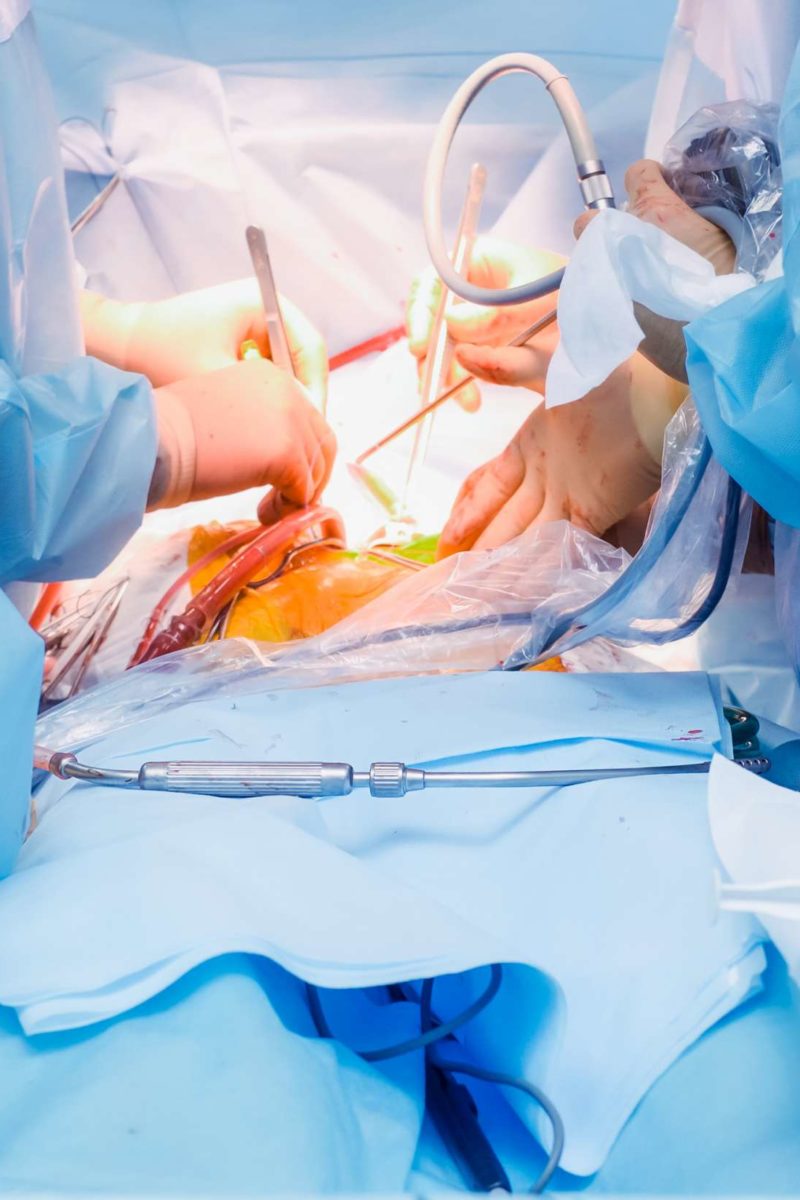 Is Laparoscopy Considered Major Surgery