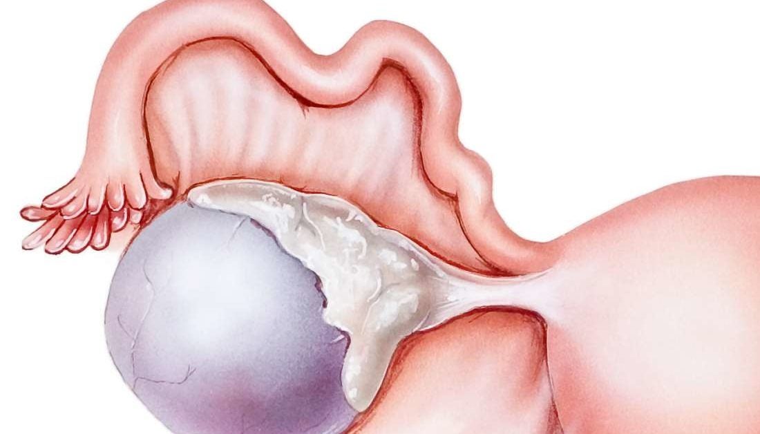 Complex ovarian cyst: Symptoms, risks, pictures, surgery