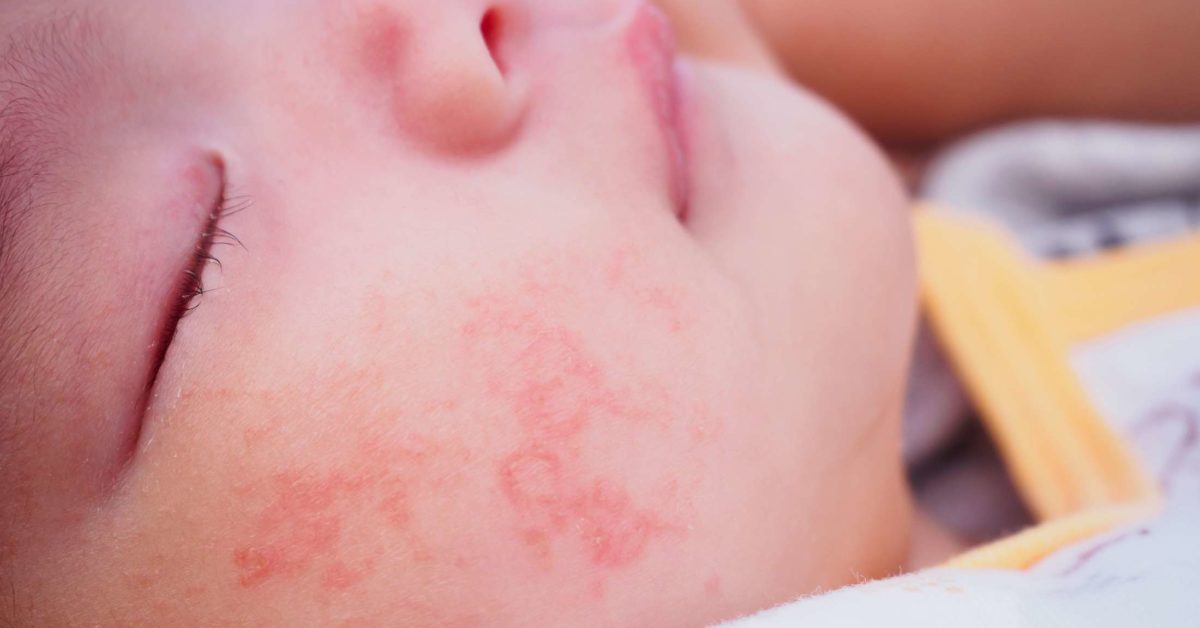 How do you know if your baby is having a allergic reaction