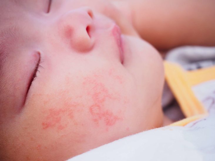 Hives on baby face after eating