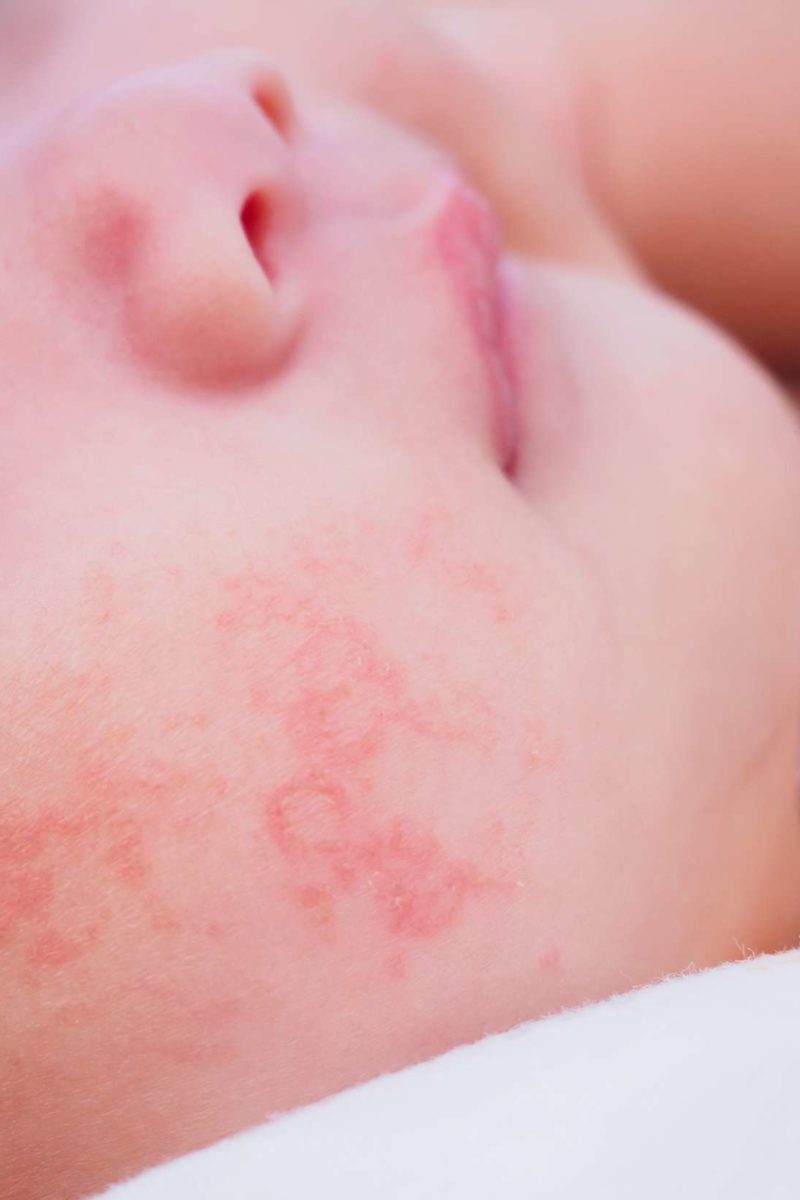 allergic-reaction-in-baby-treatment-and-pictures