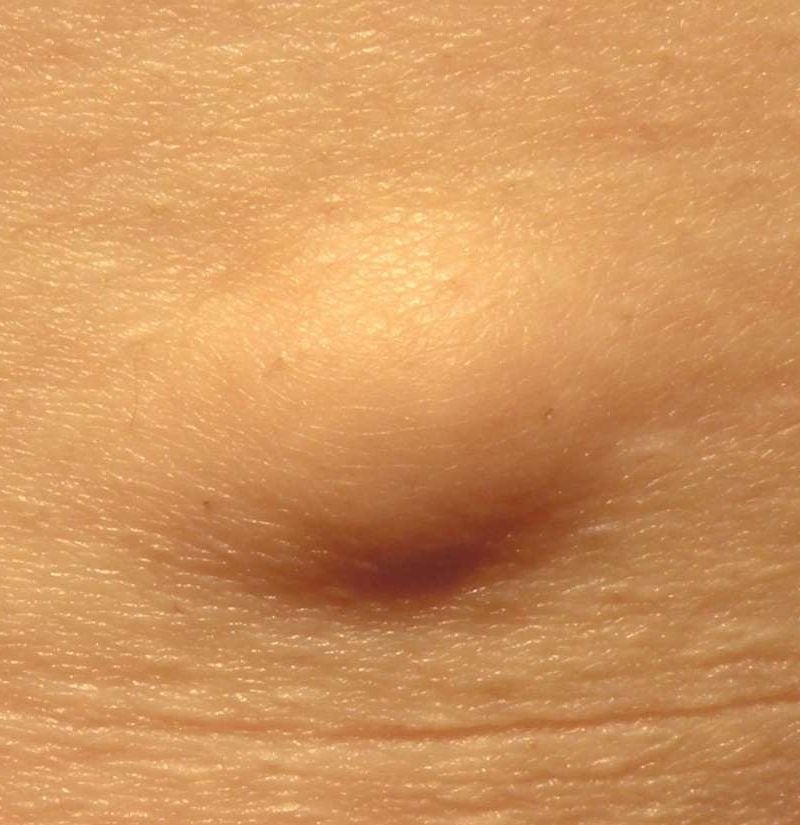 When to worry about a lump under skin