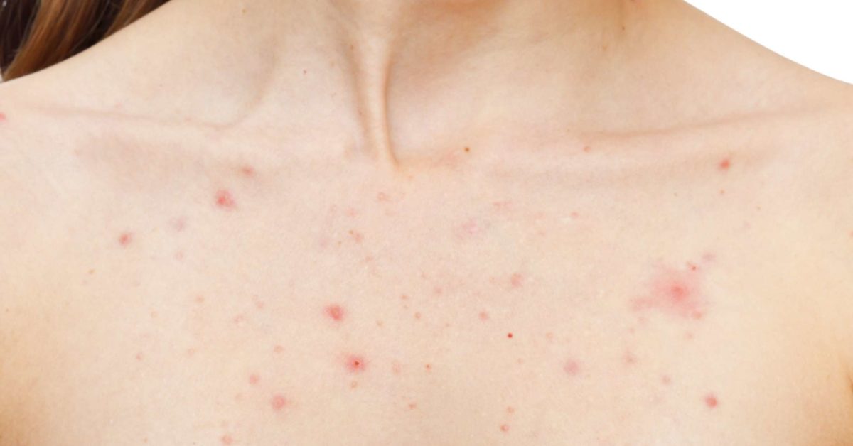 Pimples On Breasts Causes And How To Get Rid Of Them 